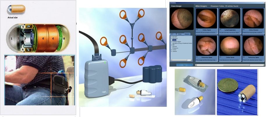 Капсульная эндоскопия презентация